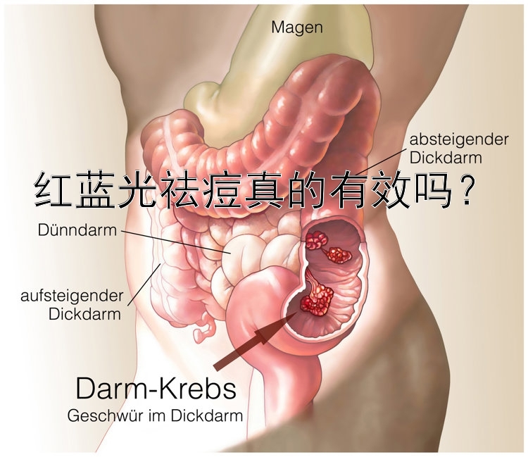 红蓝光祛痘真的有效吗？